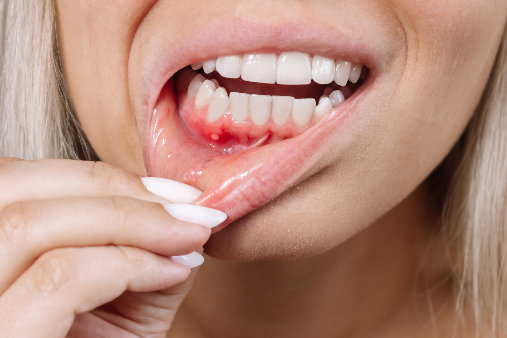 Sore Mouth Ulcer - Ballincollig Dentist advice